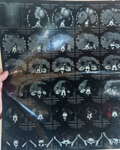 Abdominal CT scan showed hepato- splenomegaly and extensive metastatic deposits in liver and spleen.